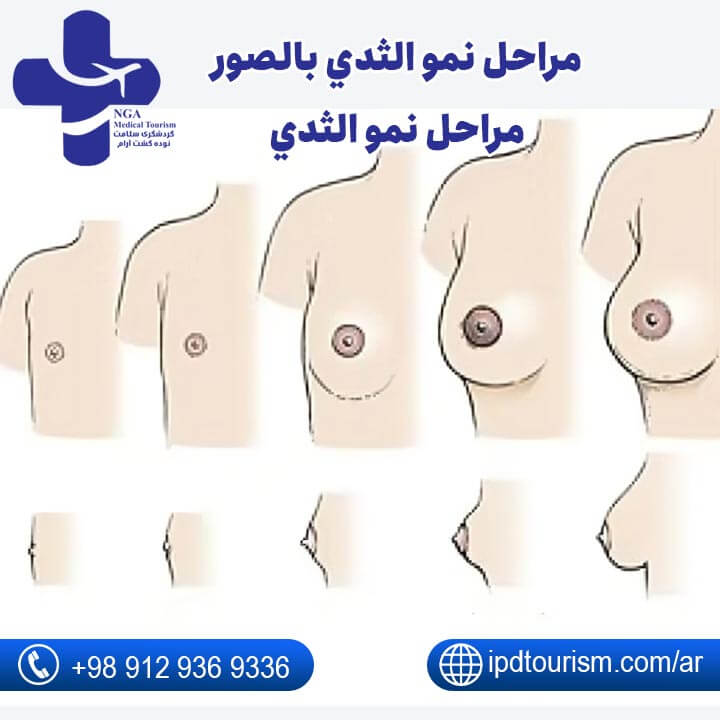 تكبير الثدي-8