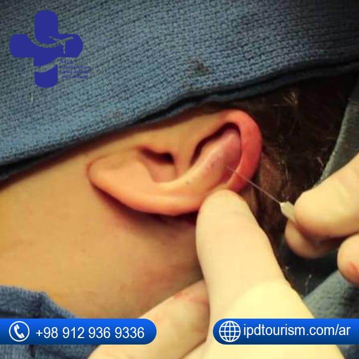 أنواع جراحة تجميل الأذن