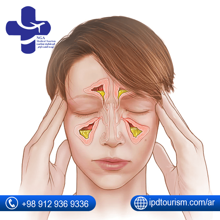 اعراض-التهاب-الجيوب-الأنفية