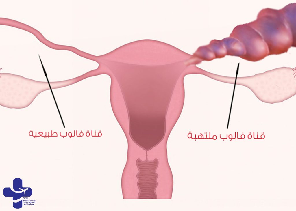 انسداد قناة فالوب