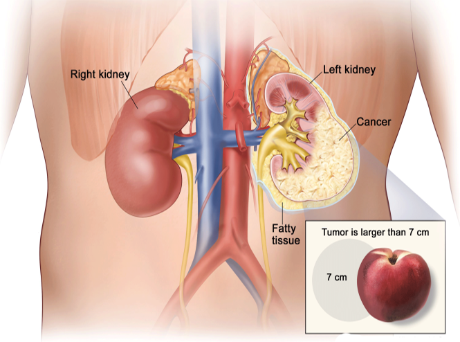 علاج سرطان الكلى