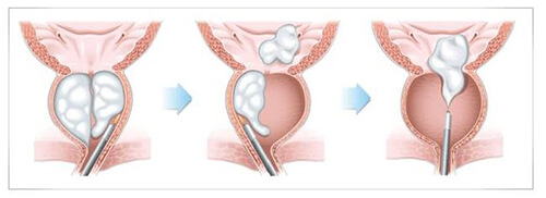 مراحل جراحة البروستاتا