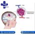 التشوه الشرياني الوريدي الدماغي فی ایران | ما اعراض تشوه شرياني وريدي؟
