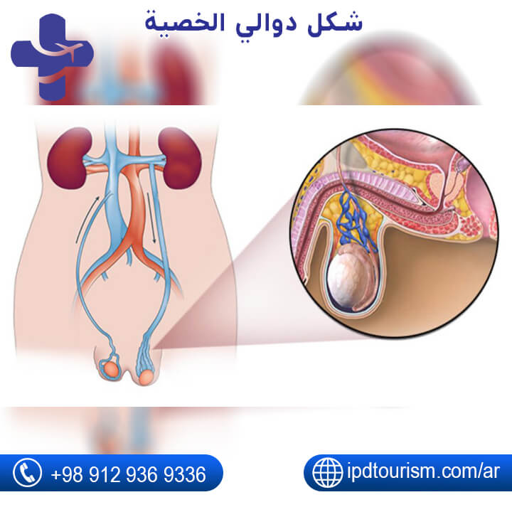 شكل دوالي الخصية2