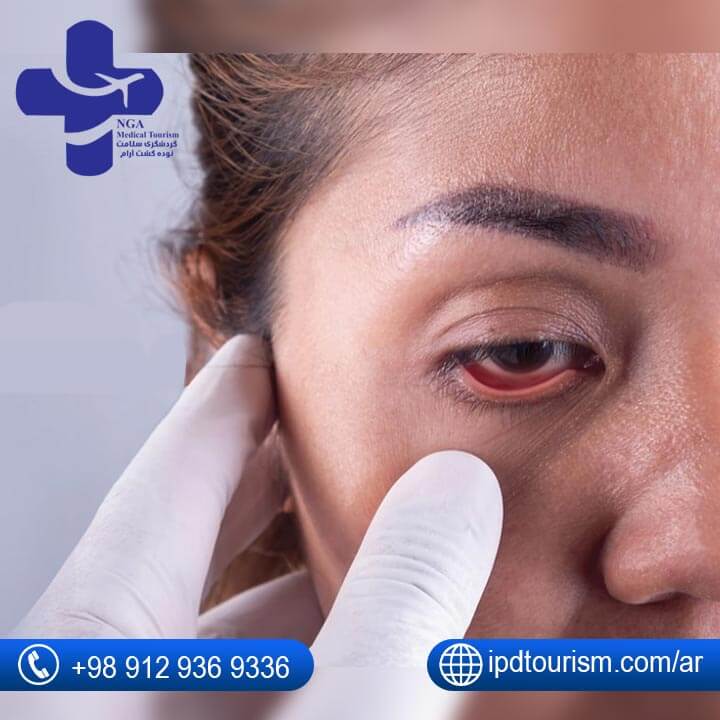أمراض العيون الجلوكوما في إیران