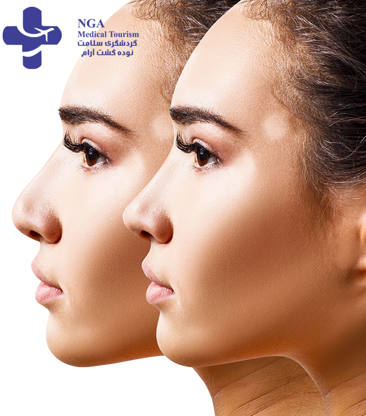 أسعار عمليات تجميل الأنف في إيران