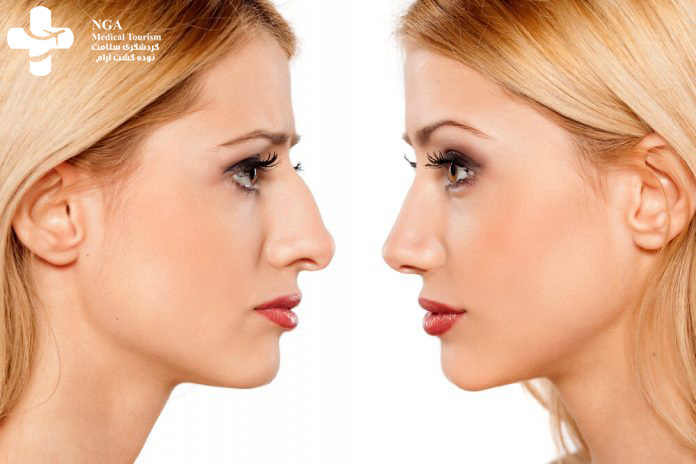 أسعار عمليات تجميل الأنف في إيران