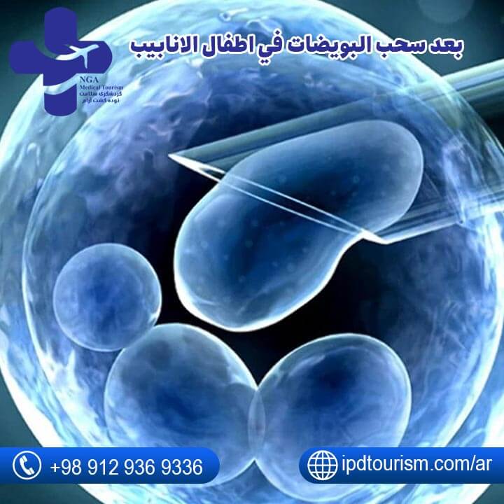 عملية سحب البويضات-7