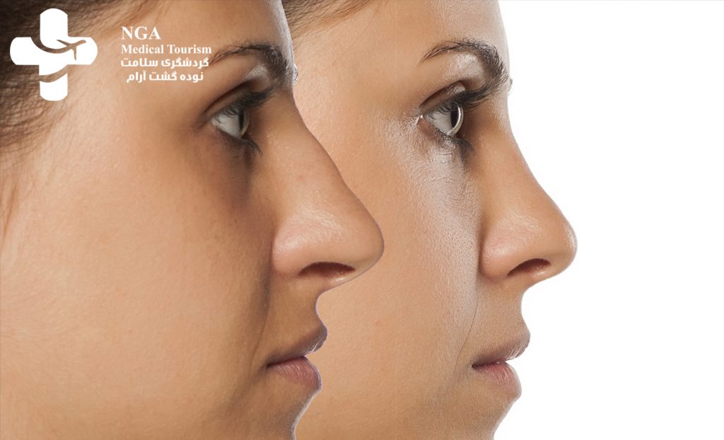 أسعار عمليات تجميل الأنف في إيران