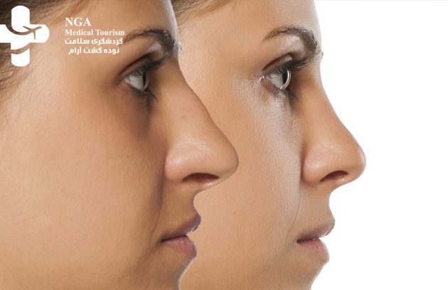 أسعار عمليات تجميل الأنف في إيران