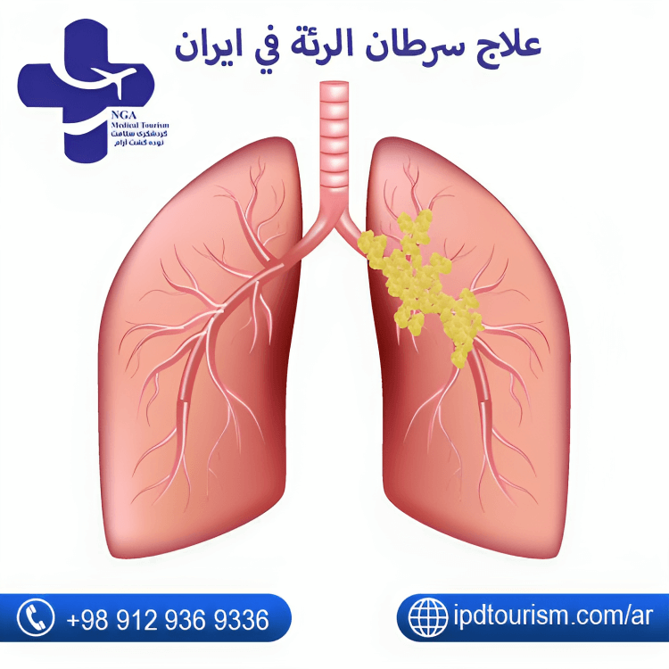 علاج سرطان الرئة في ایران