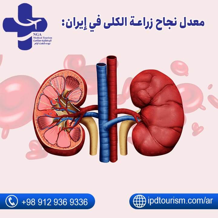 معدل نجاح زراعة الكلى في إيران