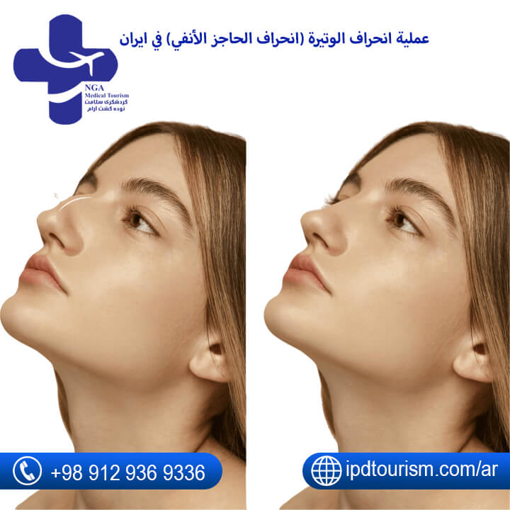 عملية تعديل الحاجز الانفي في إيران-80