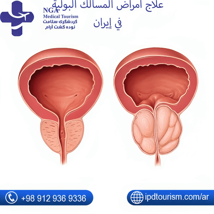 علاج أمراض المسالك البولية