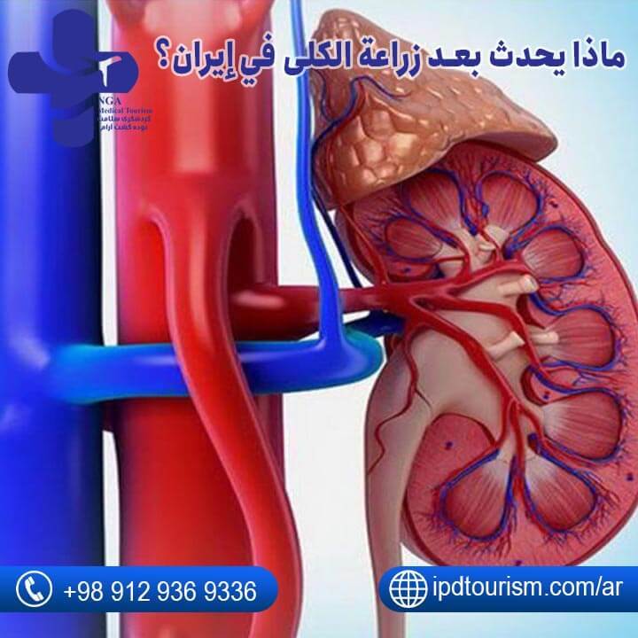 ماذا يحدث بعد زراعة الكلى في إيران؟