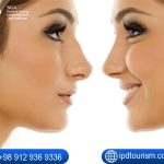 أسعار عمليات تجميل الأنف في إيران