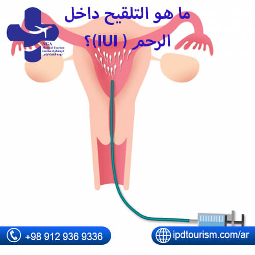 ما هو التلقيح داخل الرحم ( IUI)؟