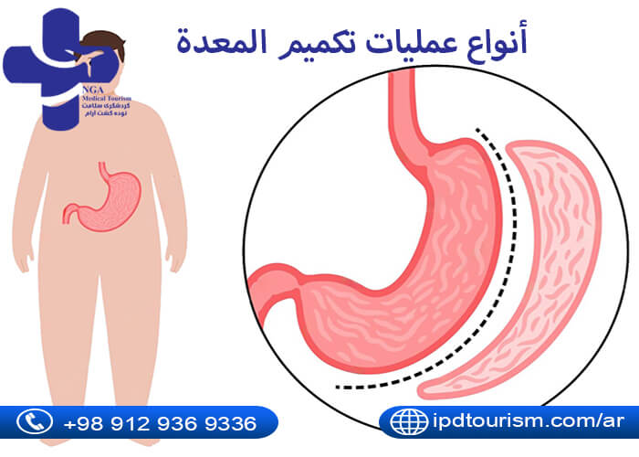 أنواع عمليات تكميم المعدة_