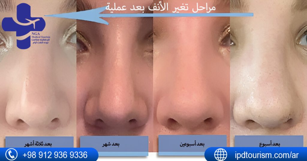 مراحل تغير الأنف بعد عملية التجميل