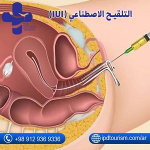 التلقيح الاصطناعي (IUI)