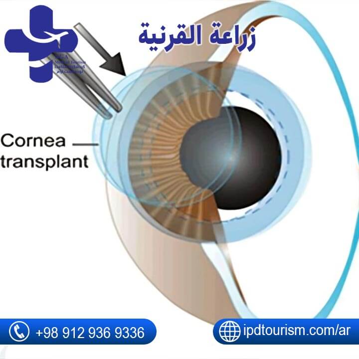 جراحة العیون-3