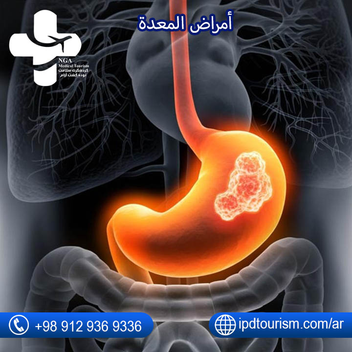 أمراض المعدة الخطيرة