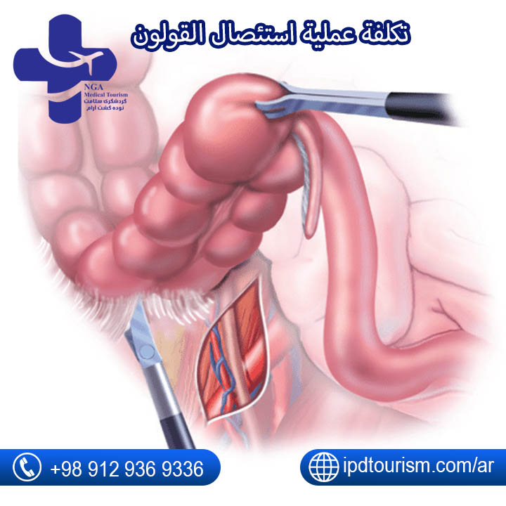 تكلفة عملية استئصال القولون