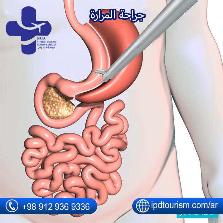 عمليات ربط المعدة