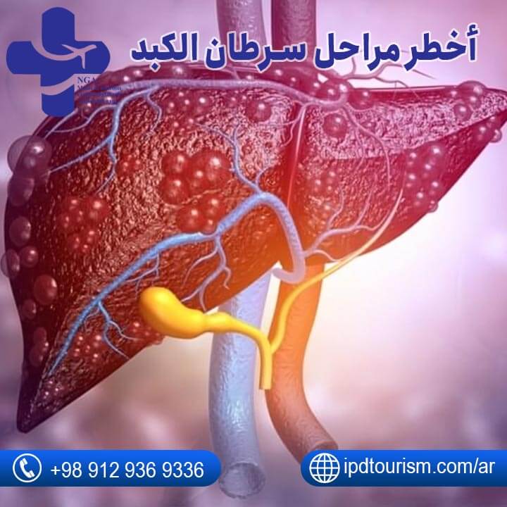 علاج سرطان الكبد-6