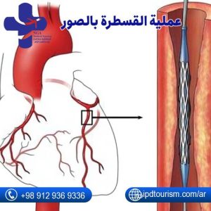 قسطرة القلب-7