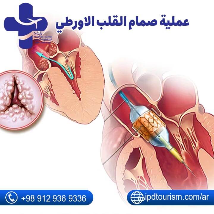 عملية صمام القلب-4