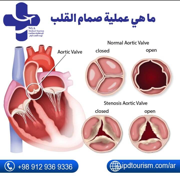 عملية صمام القلب-1