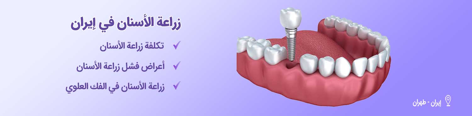 زراعة الأسنان-شاخص