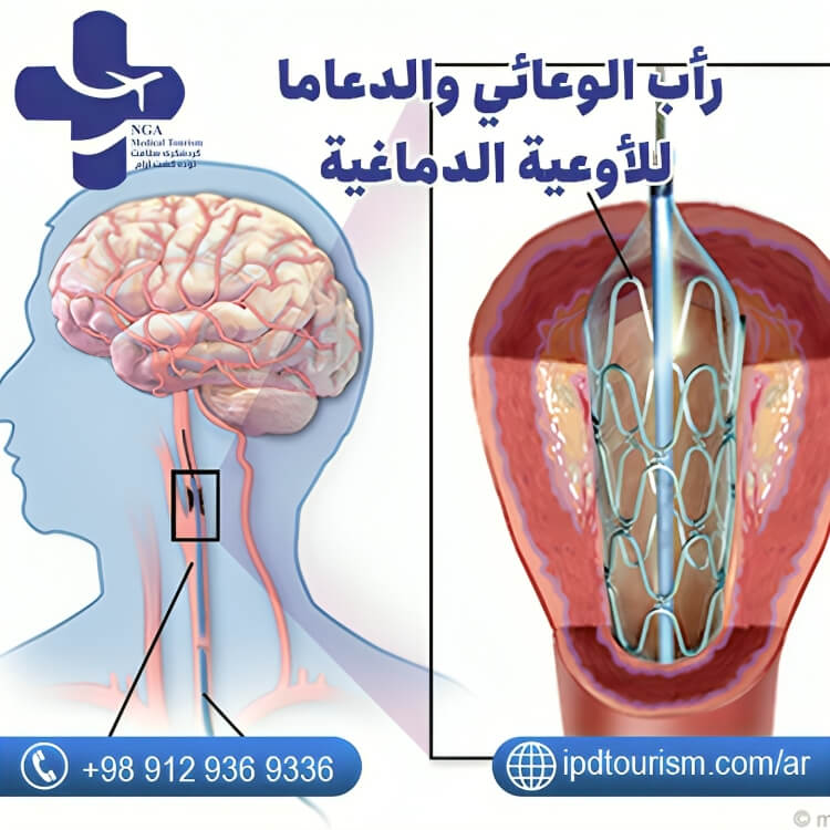 جراحة الأعصاب-3