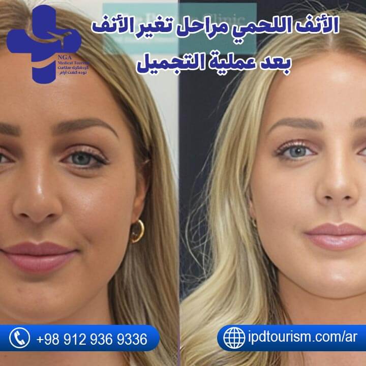 عملية تجميل الأنف-57