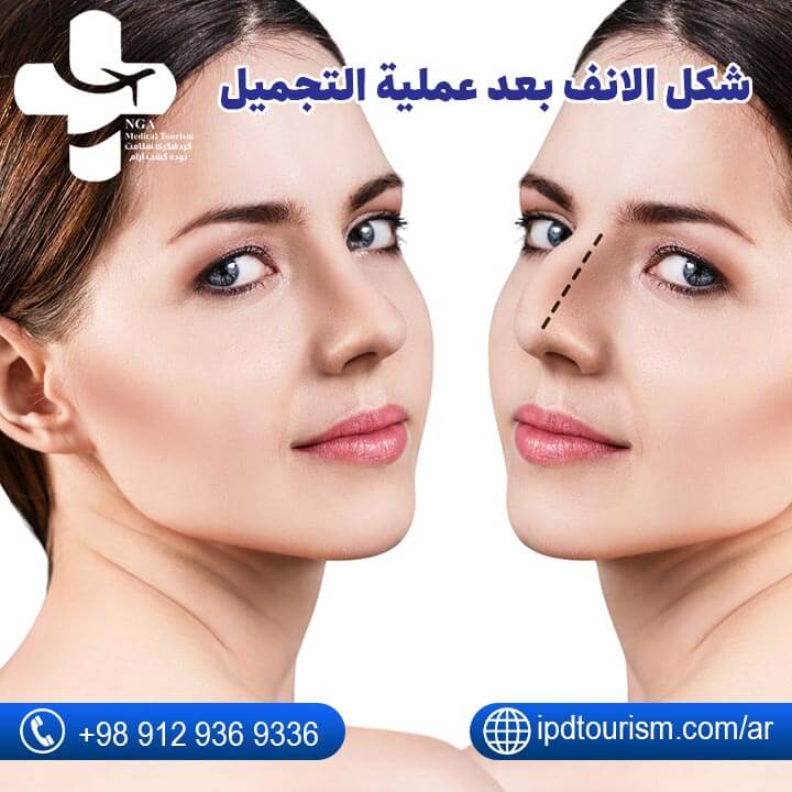 عملية تجميل الأنف-58