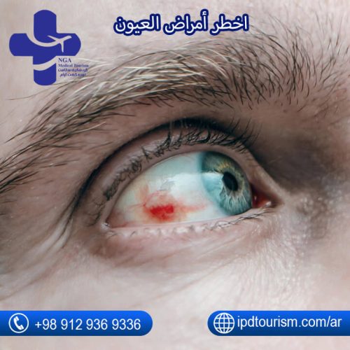 أمراض العيون-7