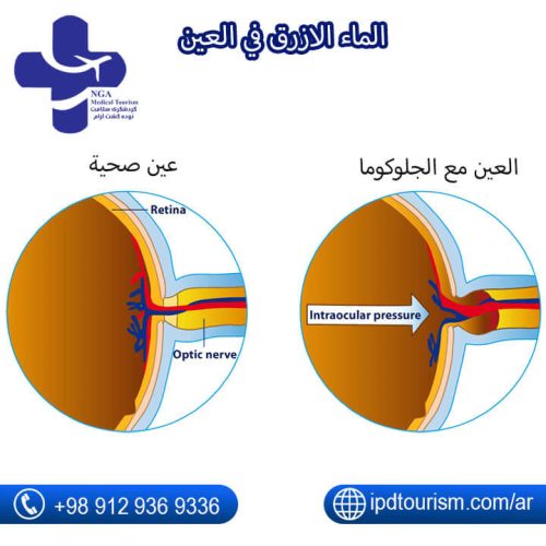 الماء الازرق في العين