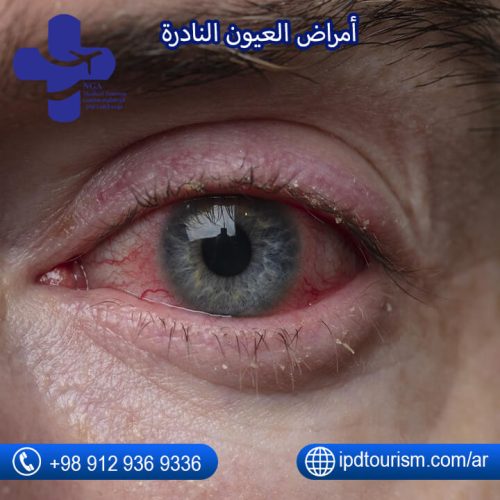 أمراض العيون-5