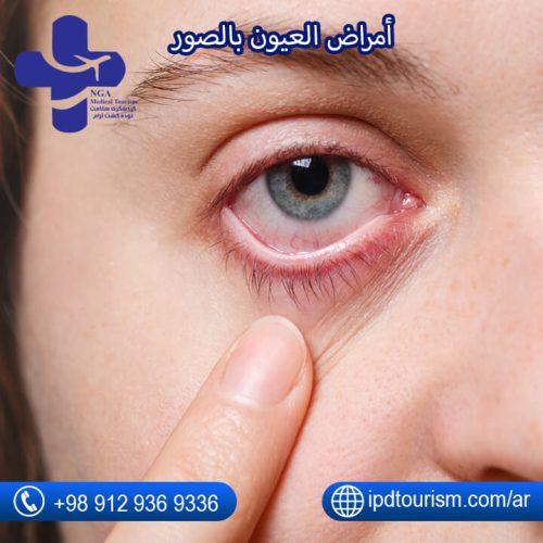 أمراض العيون-2