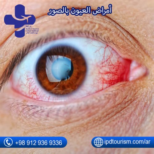 أمراض العيون-3