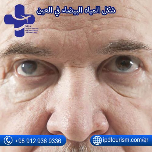 الماء الأبيض في العين-4