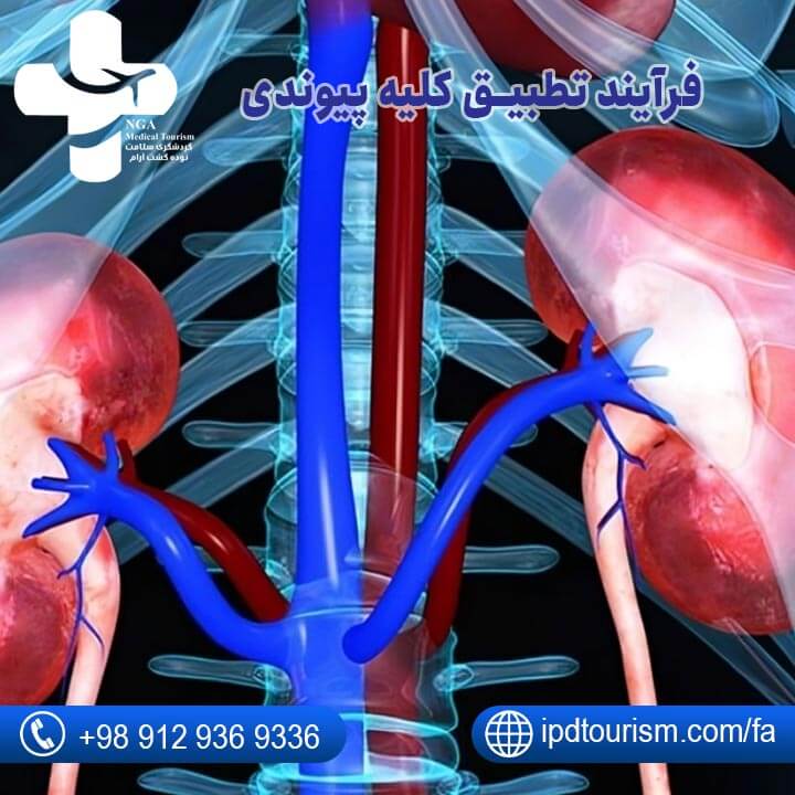 پیوند کلیه-8