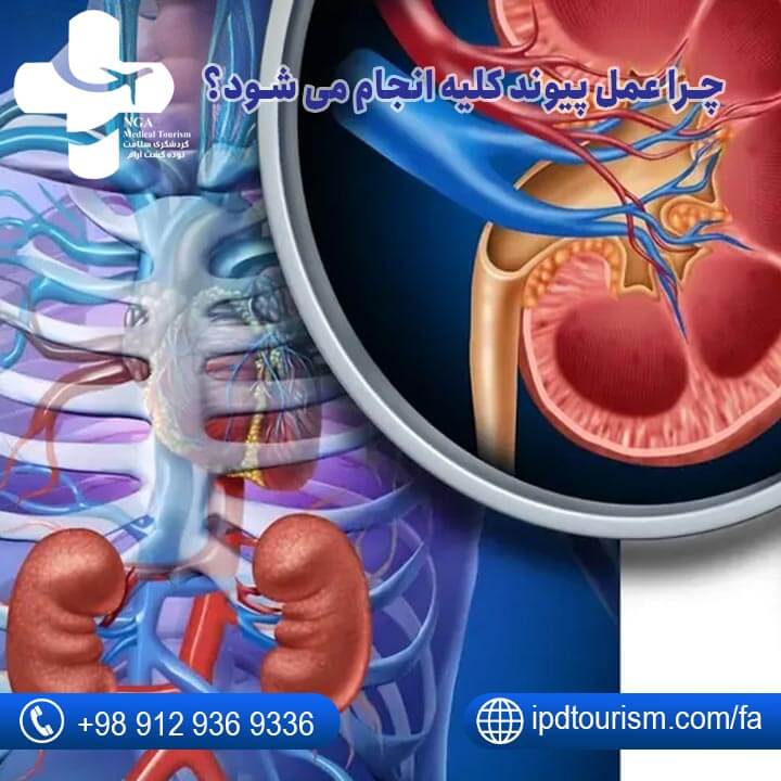 پیوند کلیه-1