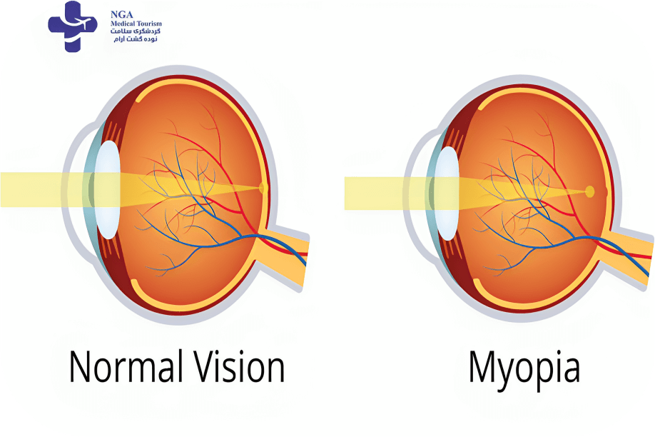 Myopia in Iran