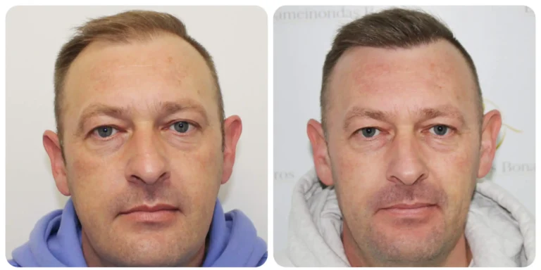 hair transplant before and after: