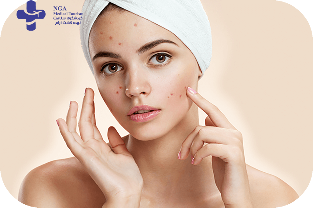 best skincare treatment for acne