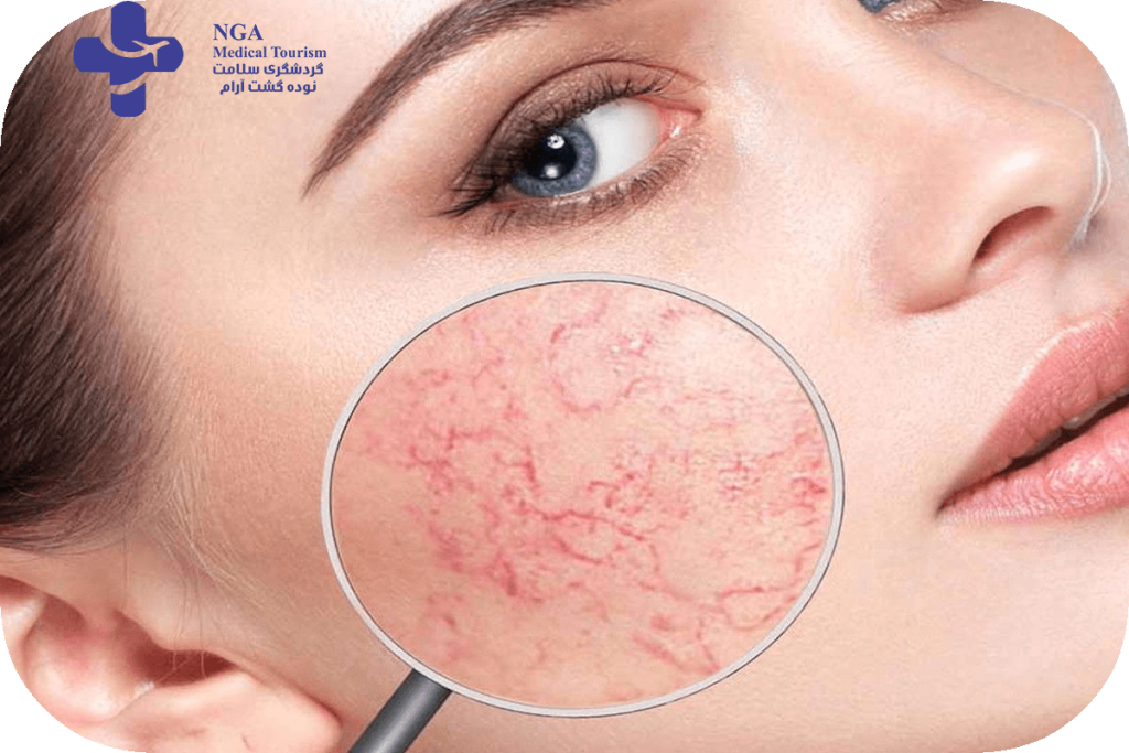 skin care treatment for rosacea