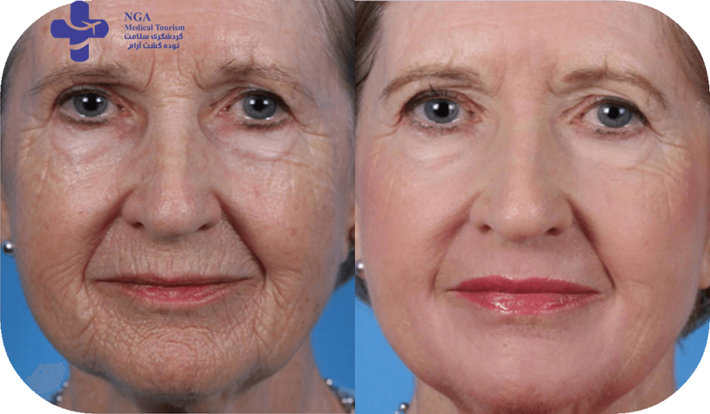 laser skin resurfacing before and after: