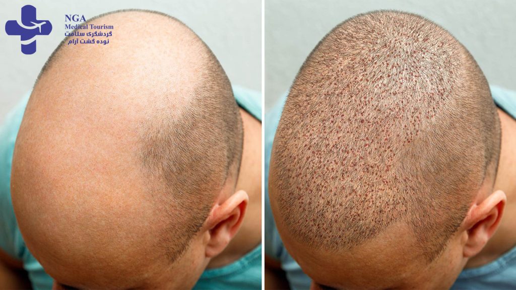 HAIR TRANSPLANT RECOVERY: WHAT TO EXPECT?
